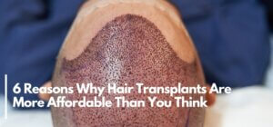 6 Reasons Why Hair Transplants Are More Affordable Than You Think