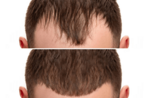 During Hair Transplant Recovery