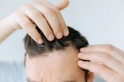 Receding Hairline