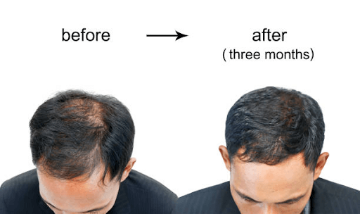 Low-Cost Hair Transplant