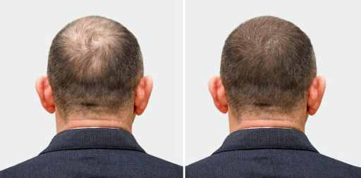 Affordable Hair Transplant in Istanbul