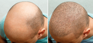 Growth at Hair Transplant Istanbul