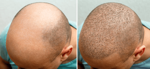 Growth at Hair Transplant Istanbul