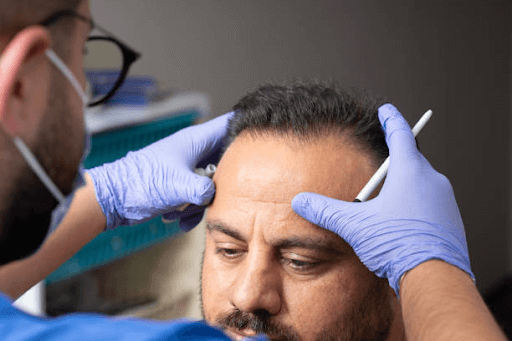 Hair Transplant Journey